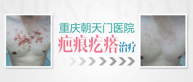 重庆疤痕修复<a href='http://4g.cqpfk.net/yyjs/index.html' target='_blank' title='朝天门'><span style='color: #0000ff'><strong>朝天门</strong></span></a>好